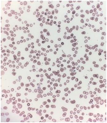 Case Report: Propranolol Therapy for Infantile Tremor Syndrome in a Child With Vitamin B12 Deficiency